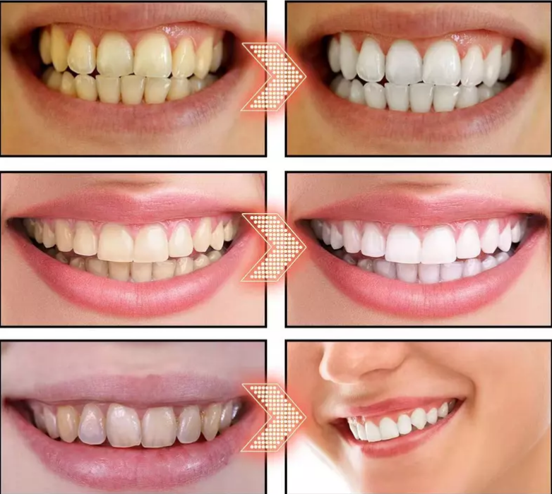 Clareador Dental Hismile | Elimina el Amarillo y Manchas